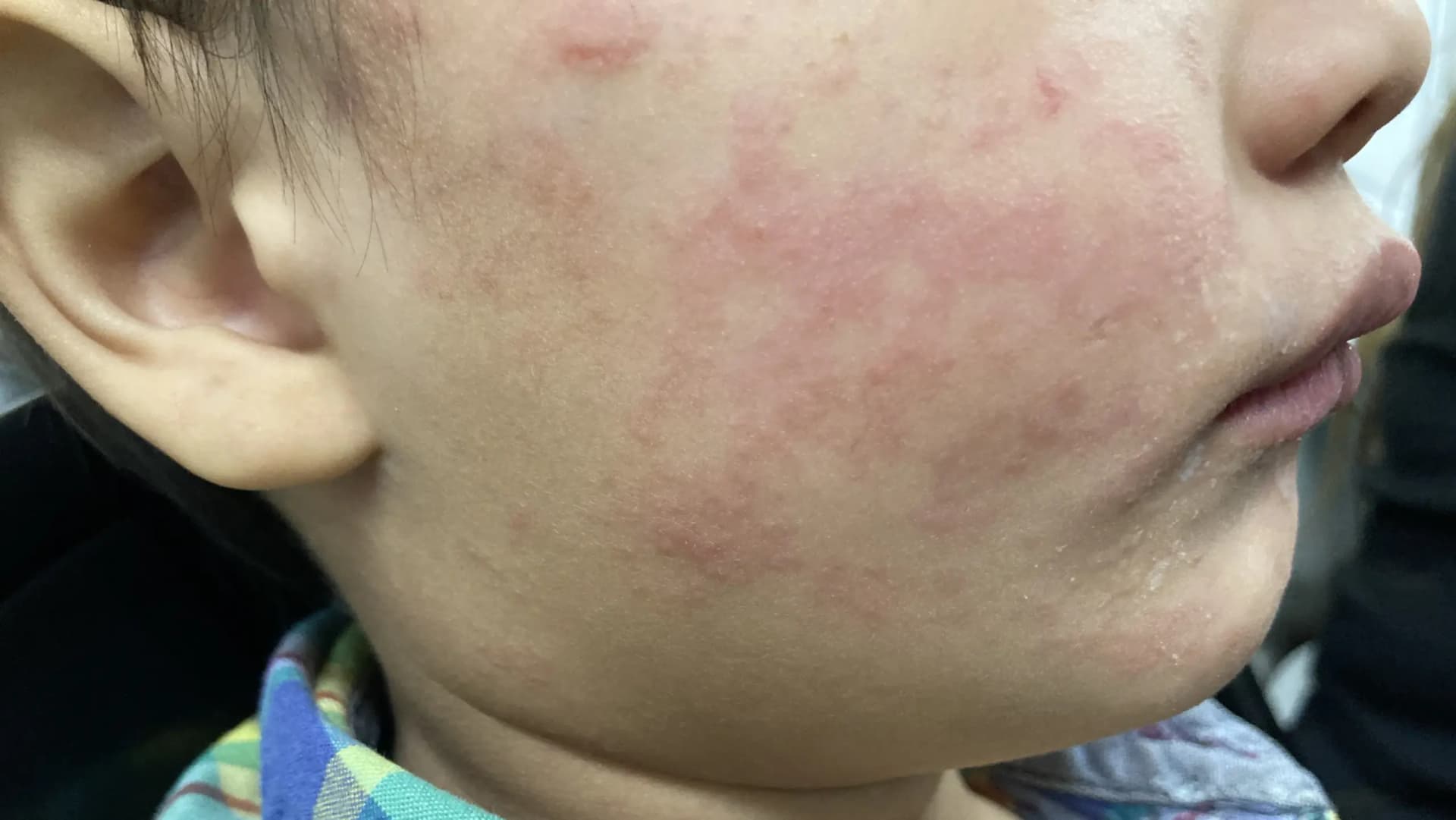 Featured image for Measles Cases Detected at Denver International Airport: Colorado On High Alert 