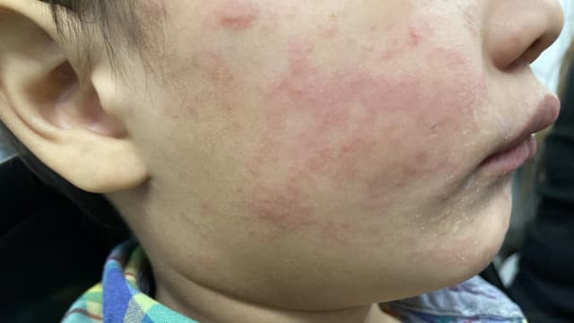 Measles Cases
