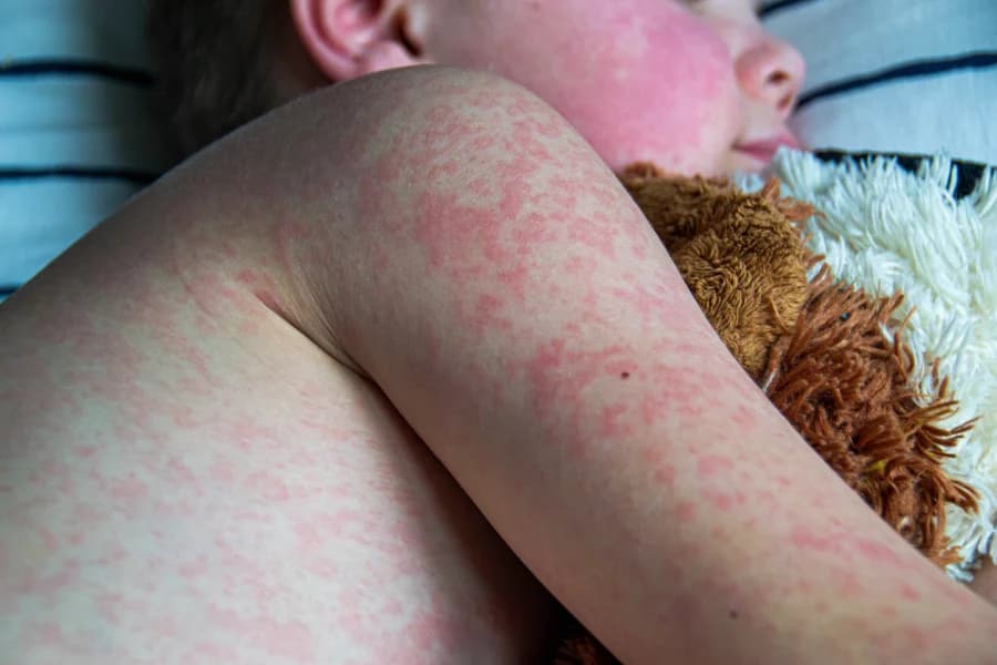 Featured image for Measles Outbreak 2025: 1,200+ Cases Across 34 U.S. States