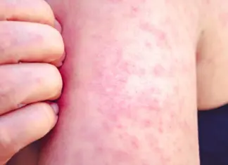 Measles Outbreak in Texas Sparks Health Emergency: 741+ Cases & Rising Measles Outbreak in Texas