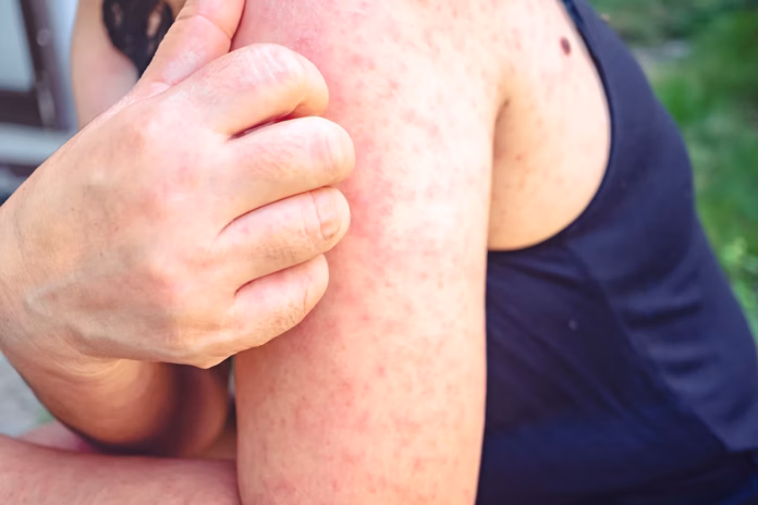measles