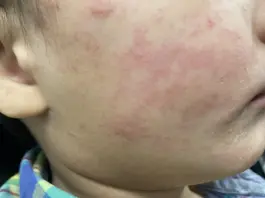 Measles Cases Detected at Denver International Airport: Colorado On High Alert  Measles Cases