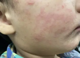 Measles Cases Detected at Denver International Airport: Colorado On High Alert Measles Cases