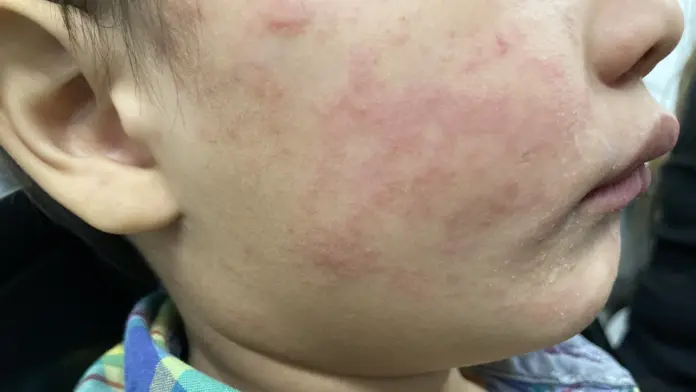 Measles Cases