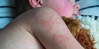 Measles Outbreak 2025: 1,200+ Cases Across 34 U.S. States Measles Outbreak 2025