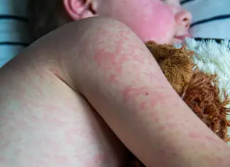Measles Outbreak 2025: 1,200+ Cases Across 34 U.S. States Measles Outbreak 2025